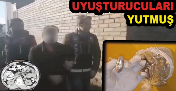 MİDESİNDEN 1 KİLO ESRAR ÇIKTI